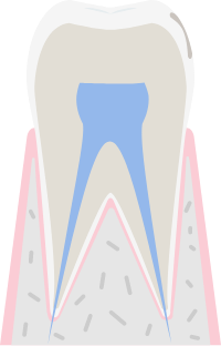 虫歯の進行度Co（シーオー）のイメージ図
