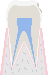 虫歯の進行度：C1のイメージ図