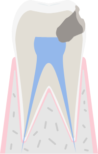 虫歯の進行度：C3虫歯の進行度Co（シーオー）のイメージ図