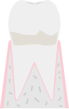 歯周病のレベル：歯肉炎のイメージ図