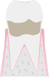 歯周病のレベル：軽度歯周炎のイメージ図