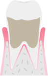 歯周病のレベル：中等度歯肉炎のイメージ図